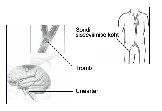 Aju angiograafia