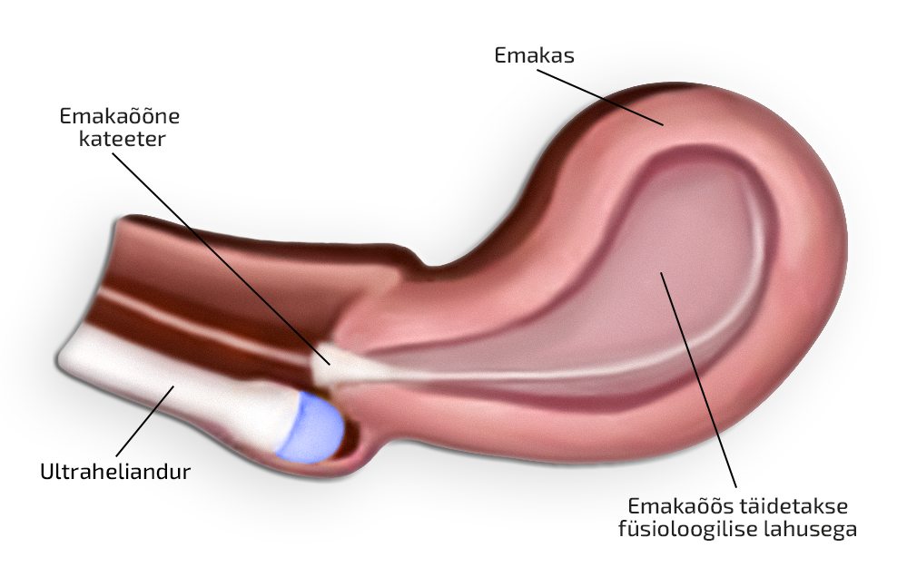 Emakaõõne uuring füsioloogilise lahusega
