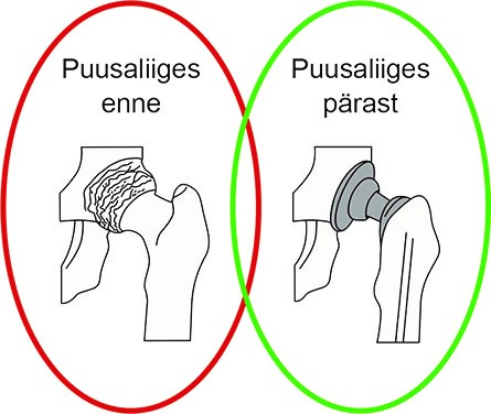 Joonis 1. Puusaliiges (vasakul puusaliiges enne operatsiooni, paremal pärast operatsiooni).