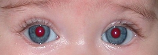 Pupilli punase refleksi normleid. Normileiu korral pupillide refleksid peegelduvad mõlemast silmast võrdsena. 
