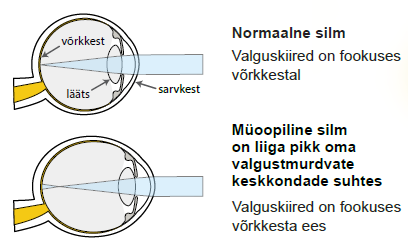 Normaalne silm vs müoopiline silm