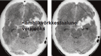 Ämblikvõrkkestaalune verejooks