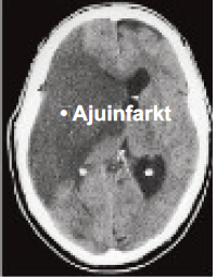 ajuinfarkt