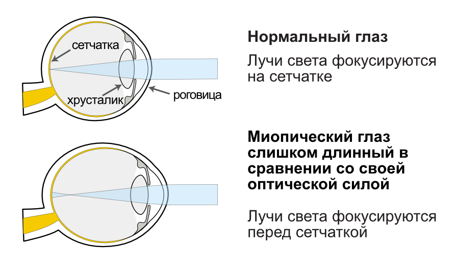 Normaalne silm vs müoopiline silm